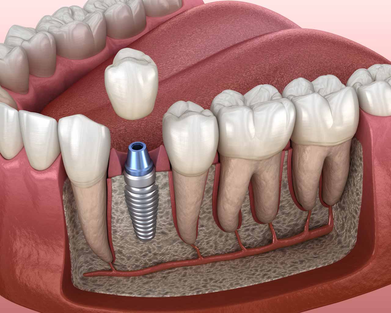 Bone Grafts In Miami The Ultimate Guide UltraSmile Miami