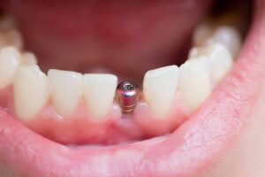 Dental Implant Cost