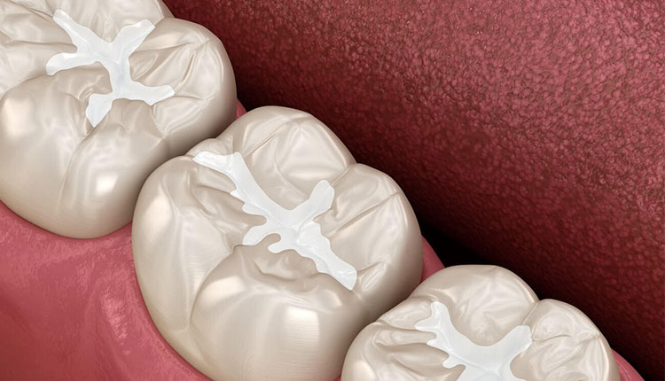 Composite Fillings for Kids: What Parents Need to Know