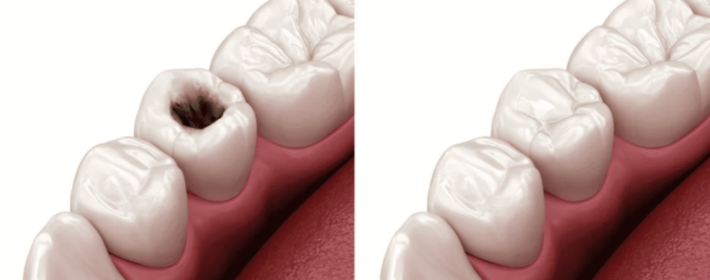 Composite Fillings