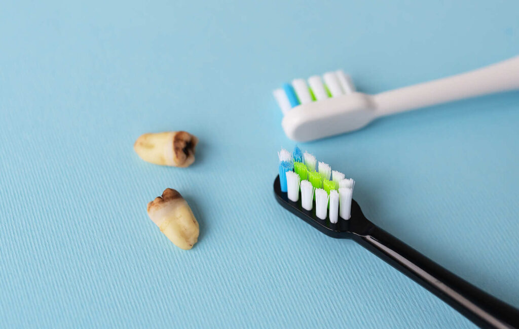 How to Prepare for Your Wisdom Teeth Extraction