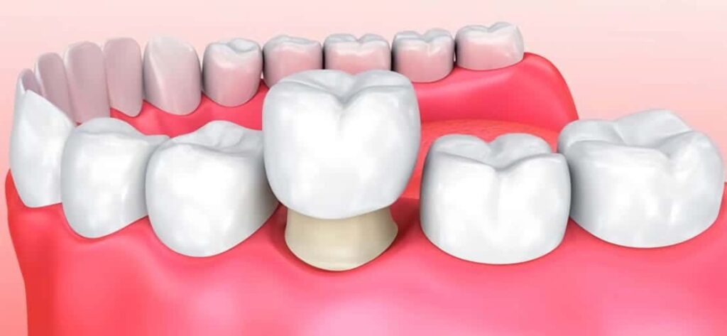 dental crowns