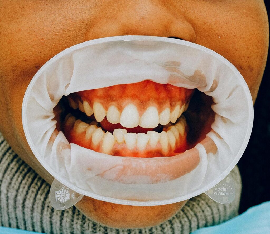 Teeth Whitening Near Miami FL