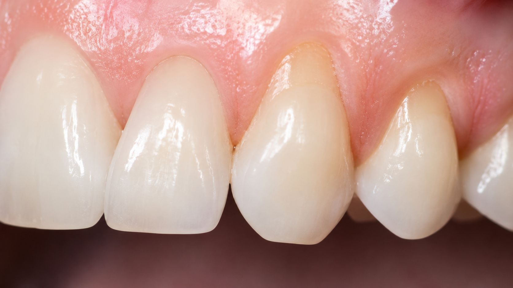 A close-up view of a patient's upper teeth showing visible signs of gum recession and exposed roots.