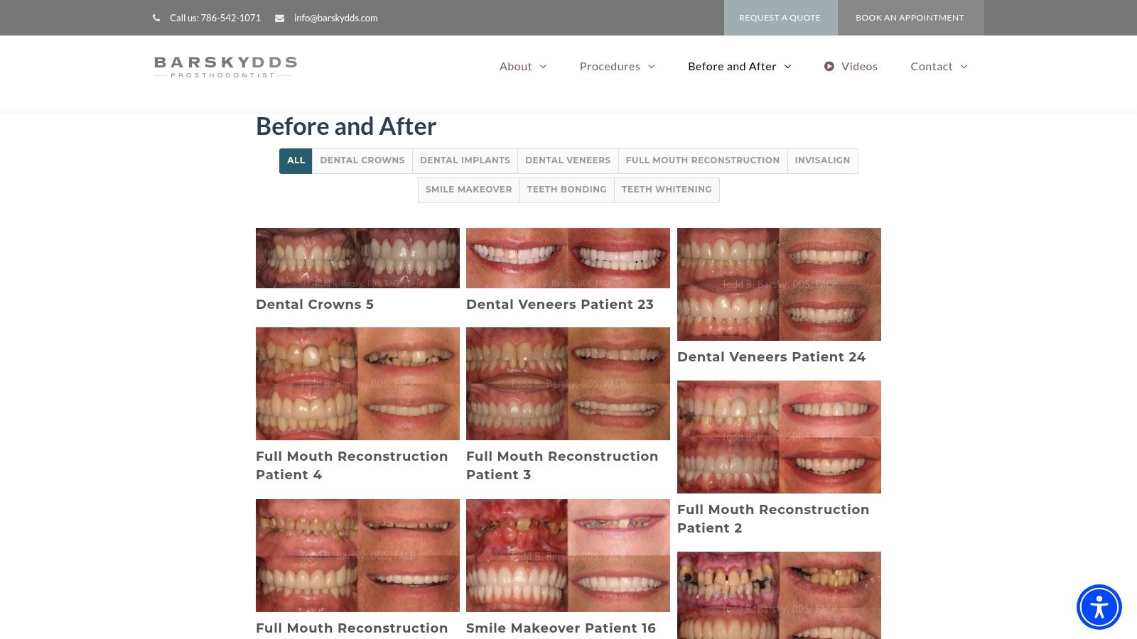 Case Study 2: Closing Gaps & Correcting Shape with Porcelain Veneers
