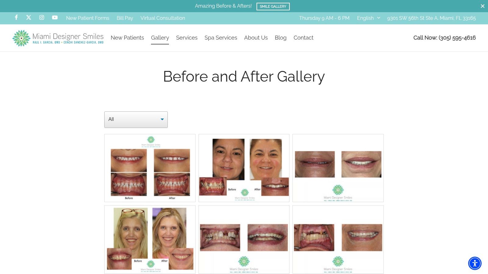 Case Study 4: Straightening a Crooked Smile with Invisalign