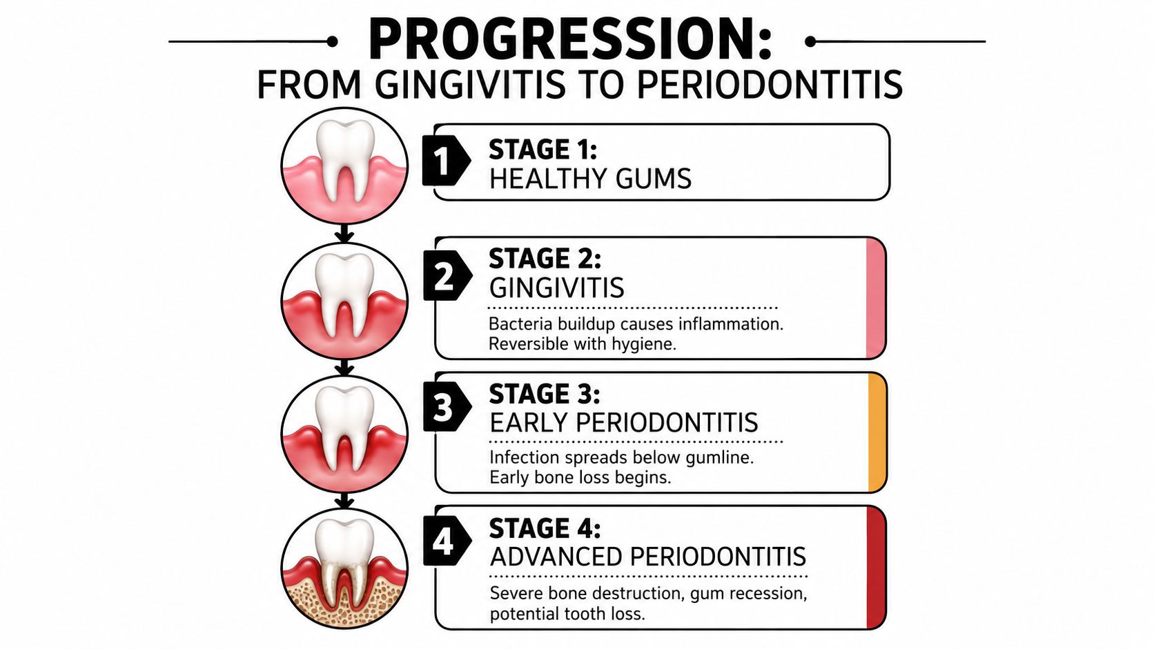 A diagram illustrating the four-stage progression from healthy gums to advanced periodontitis and tooth loss.