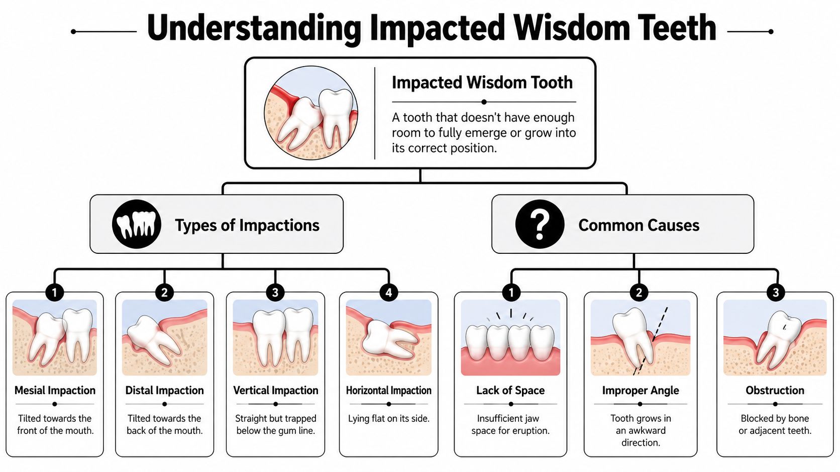 A diagram illustrating the definitions, types, and common causes of impacted wisdom teeth in human mouths.