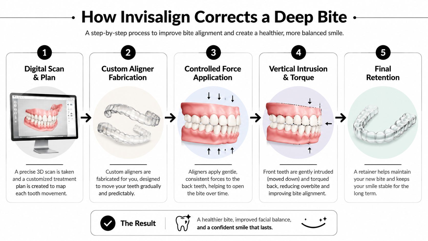 An infographic showing the five-step Invisalign process for correcting a deep bite using clear aligners.