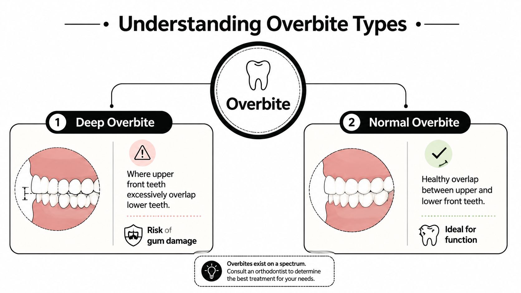 A dental diagram comparing deep overbite and normal overbite, illustrating healthy and problematic tooth overlap conditions.