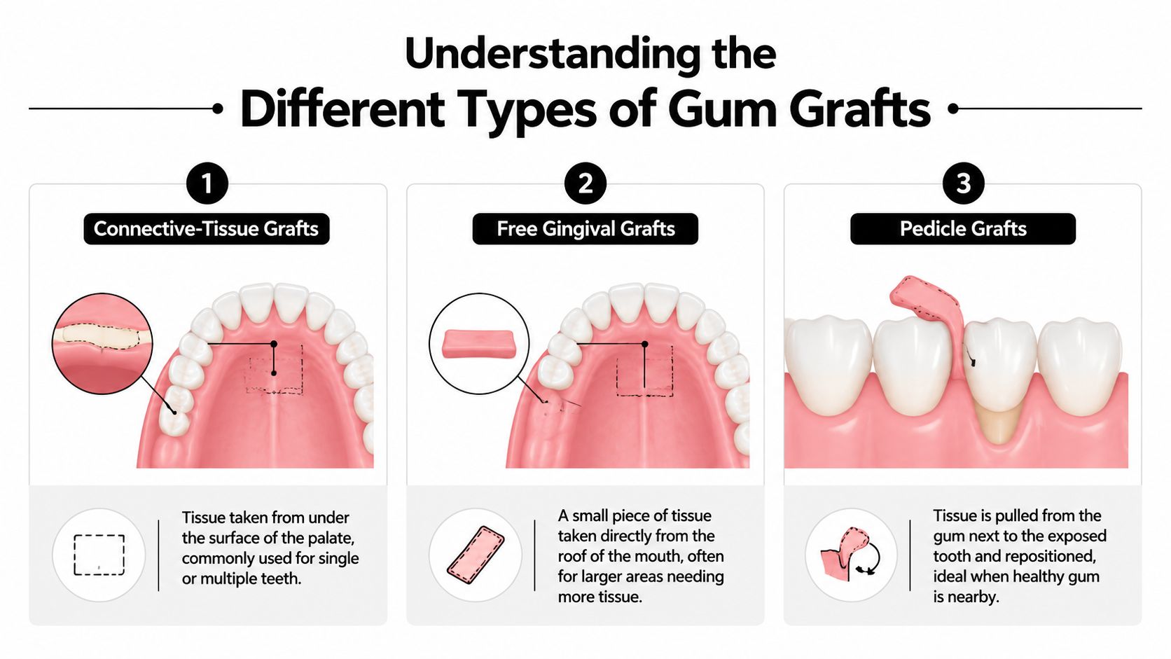 A diagram illustrating three types of dental gum graft procedures: connective-tissue grafts, free gingival grafts, and pedicle grafts.