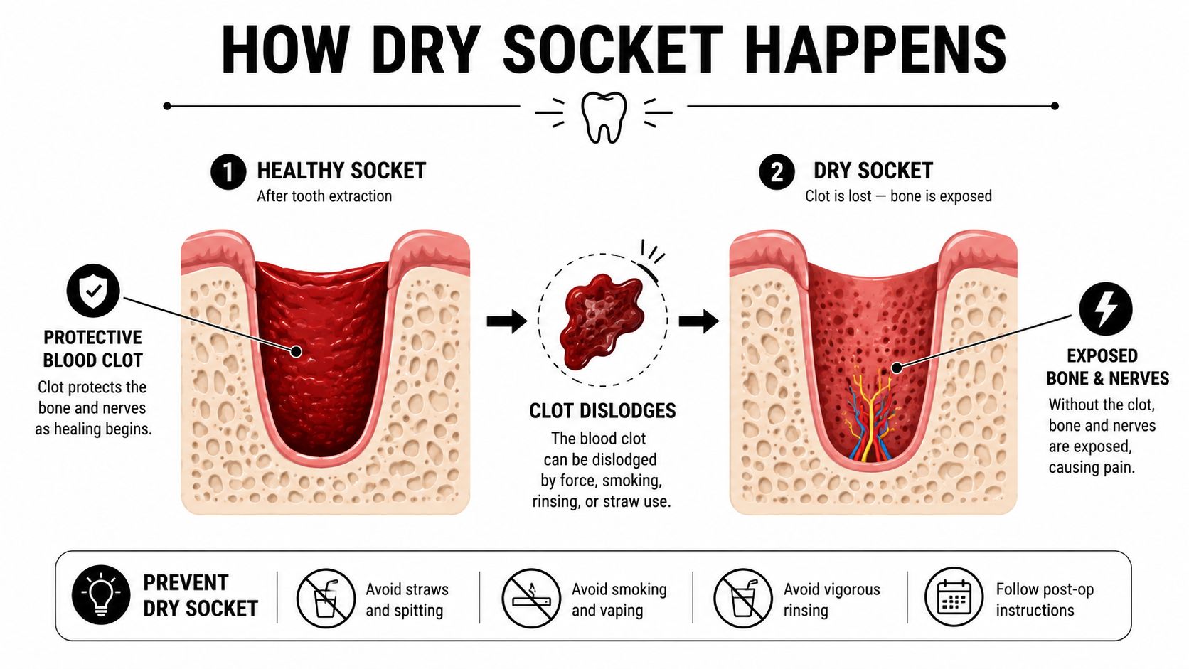 An infographic illustrating how a dry socket forms after a tooth extraction, including steps for prevention.