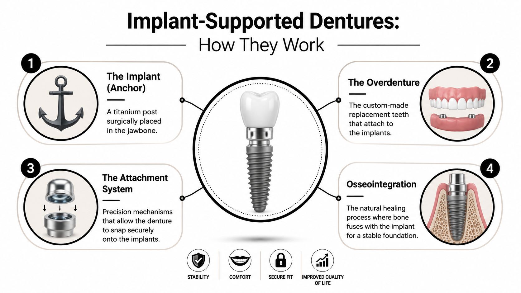 A diagram illustrating the four main components and processes involved in getting implant-supported dentures.
