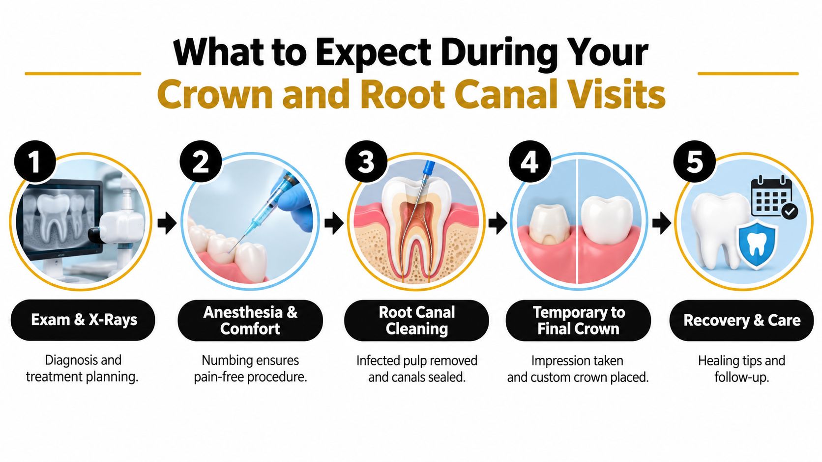 A 5-step infographic showing the dental process for a crown and root canal treatment from diagnosis to recovery.