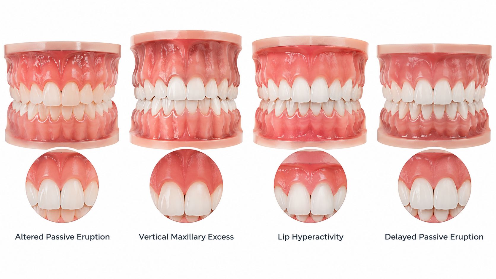 Four dental models illustrating different causes of a gummy smile including various bone and gum conditions.