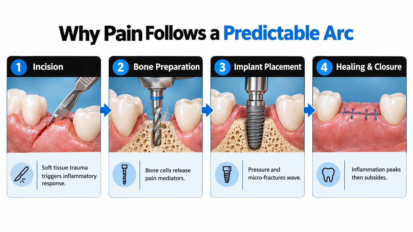 A four-step infographic illustrating the dental implant process and how each stage leads to predictable pain.