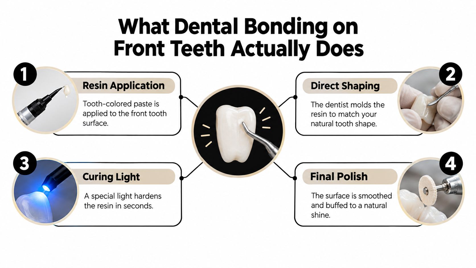 A four-step infographic explaining the dental bonding process for front teeth, including resin application, shaping, light curing, and polishing.