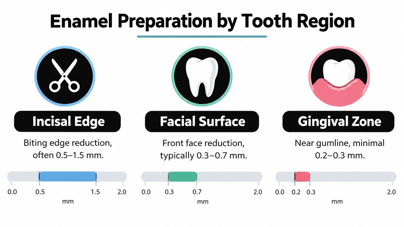 A dental infographic showing the recommended millimeters of enamel reduction for veneers by tooth region.