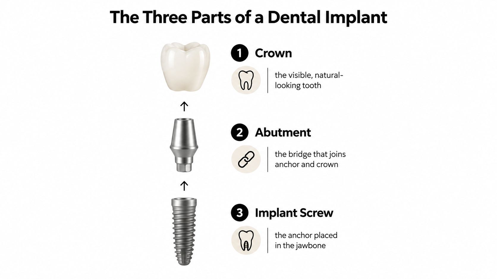 A diagram explaining the three components of a dental implant: the crown, the abutment, and the screw.