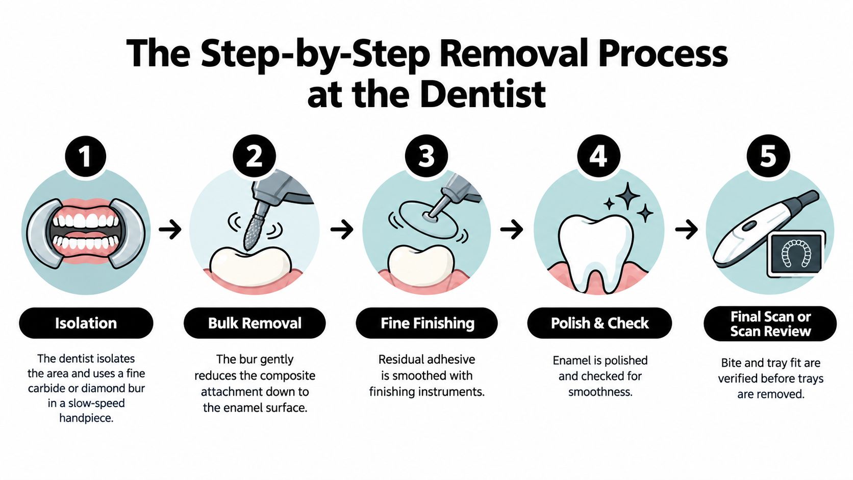 An infographic showing the five-step process for professional dental removal of Invisalign composite attachments from teeth.
